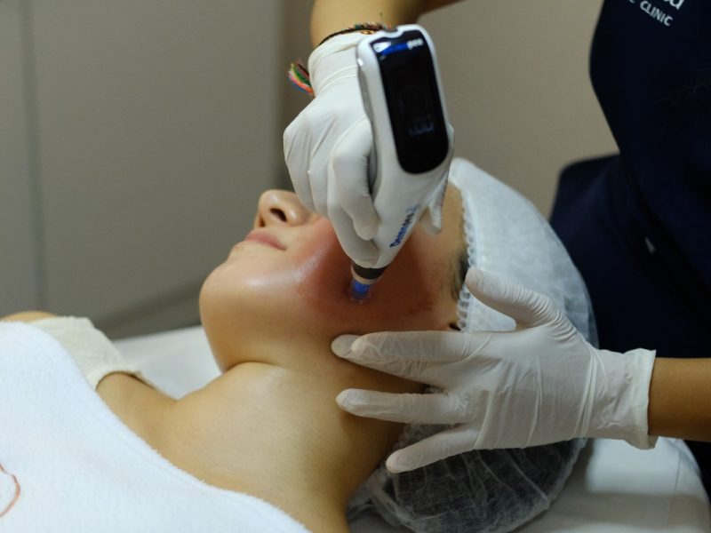 microneedling